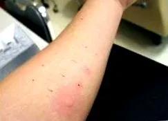 allergiás reakció vizsgálatok
