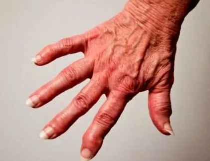 arthrosis