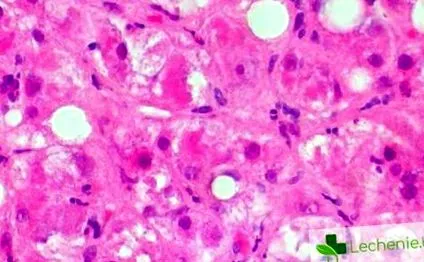 Alkoholos hepatitis felhalmozódása miatt