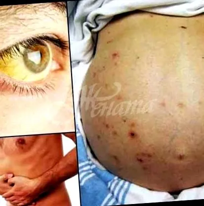 májcirrhosis