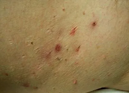 hydradenitis gennyes