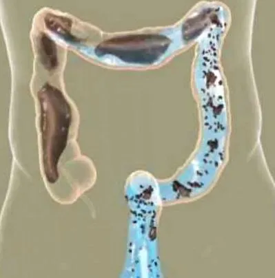 hydrocolon