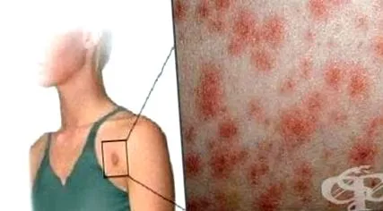 erythemában allergiás reakciókat
