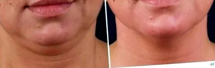 Exilis rádiófrekvenciás expert