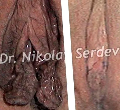 serdev labioplasztika