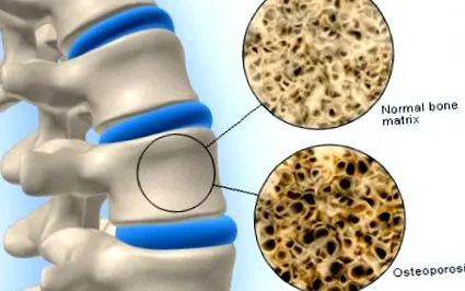 osteoporosis osteoporosis