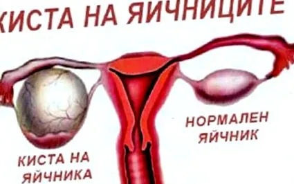 funkcionális ciszták bennem