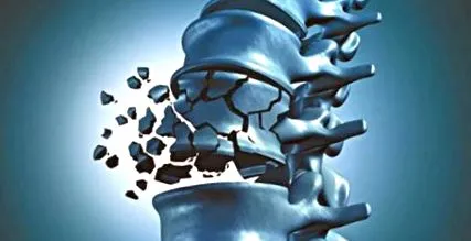 kollagén osteoporosis