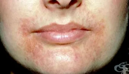 dermatitis perioralis dermatitis