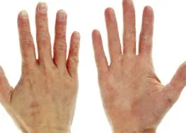 raynaud-kórban táplálkozás
