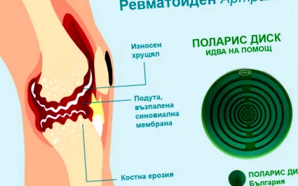 osteoarthritis rheumatoid