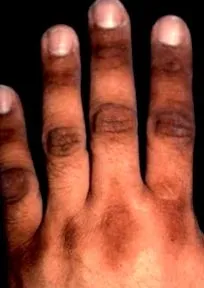 acanthosis nigricans acanthosis