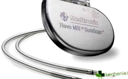 tény pacemaker vagy