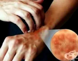 napallergia
