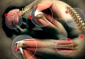 arthritis