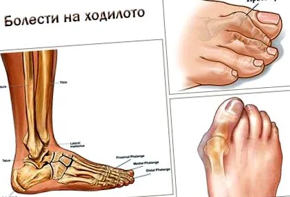 első metatarsophalangealis első metatarsophalangealis