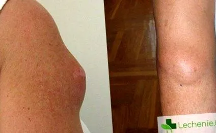 lipoma bármely életkorban