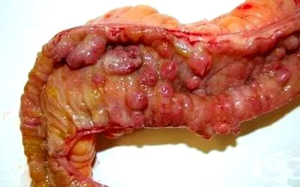 meghatározott Crohn-betegség meghatározott