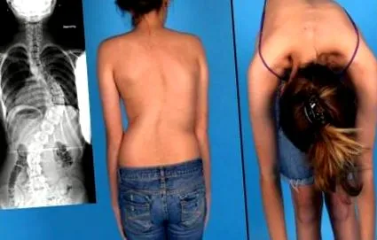 Bizonyos esetekben strukturális scoliosis
