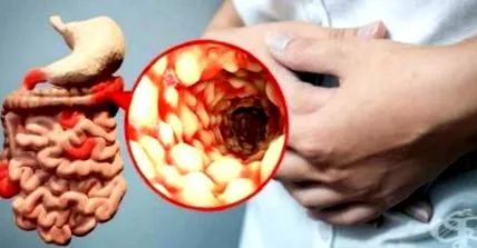 Crohn-kór regionális enteritis