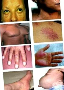 egyéb májbetegségek hepatorenalis szindróma