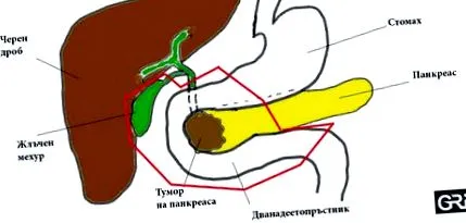 gribnev hasnyálmirigy-reszekció