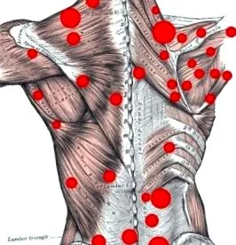 fibromyalgia