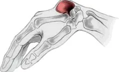 ganglion