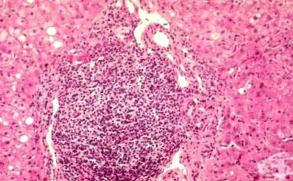 krónikus hepatitis hepatitis