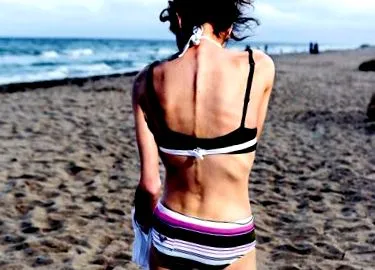 anorexiás