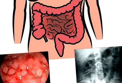 colitis krónikus