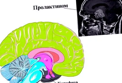 prolactinomát diagnosztizálják