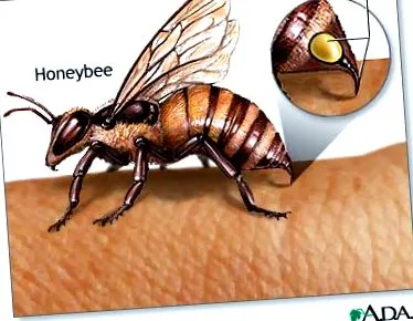 méhmérget iránti allergia