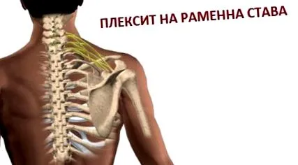 plexitis