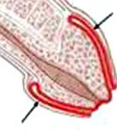 balanitis