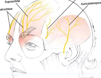neuralgia migrén