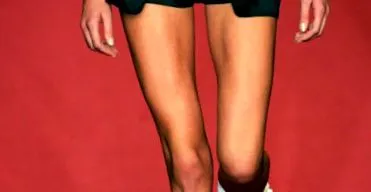 anorexiás