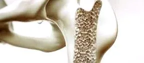 osteoporosis flex