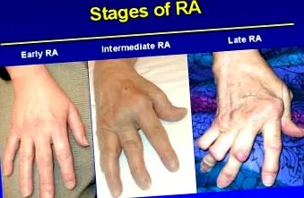 rheumatoid polyarthritis