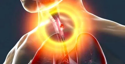 dysphagia