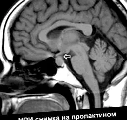 agyalapi mirigy agyalapi mirigy daganata