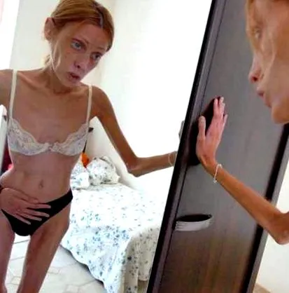 anorexiában