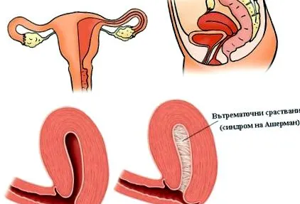 asherman-szindróma intrauterin synechiae