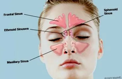 egészséges sinusitis