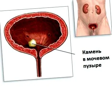 hólyaghurut hólyaghurut