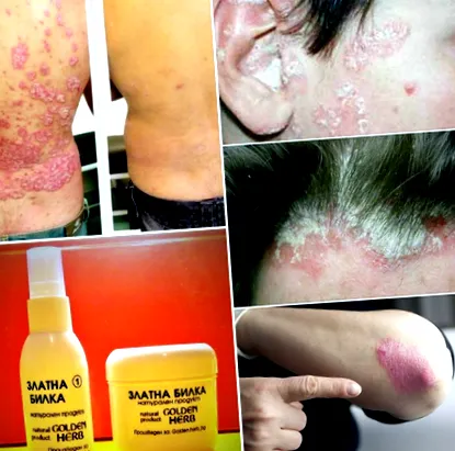dermatitist aranyfügy