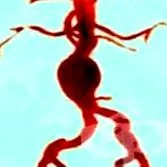 aorta aneurizma hasi