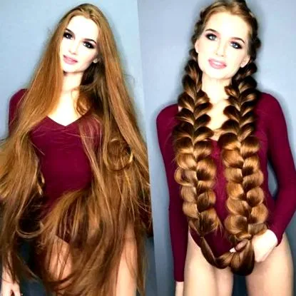 alopecia