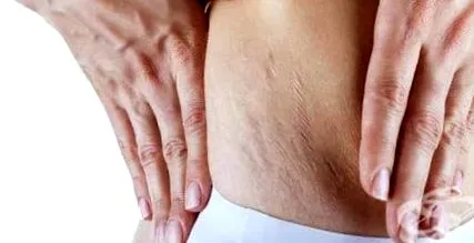 atrófiás striák általában atrófiás