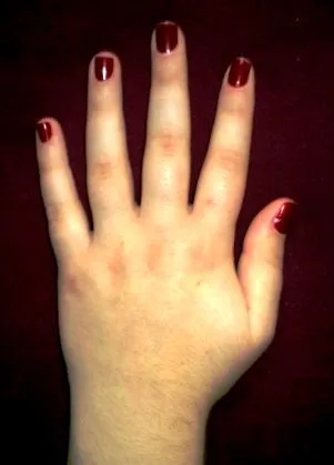 carpalis alagút okai